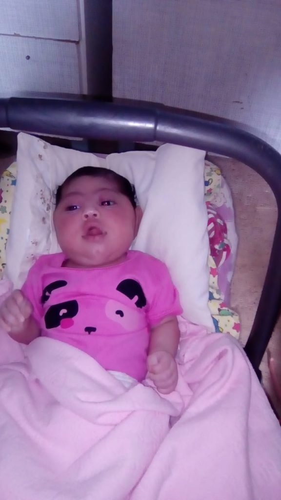Bebê com microcefalia