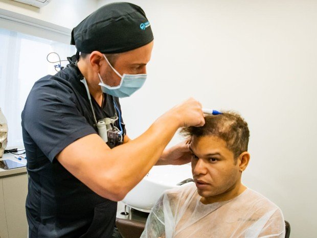 Tierry consertando transplante capilar que deu errado