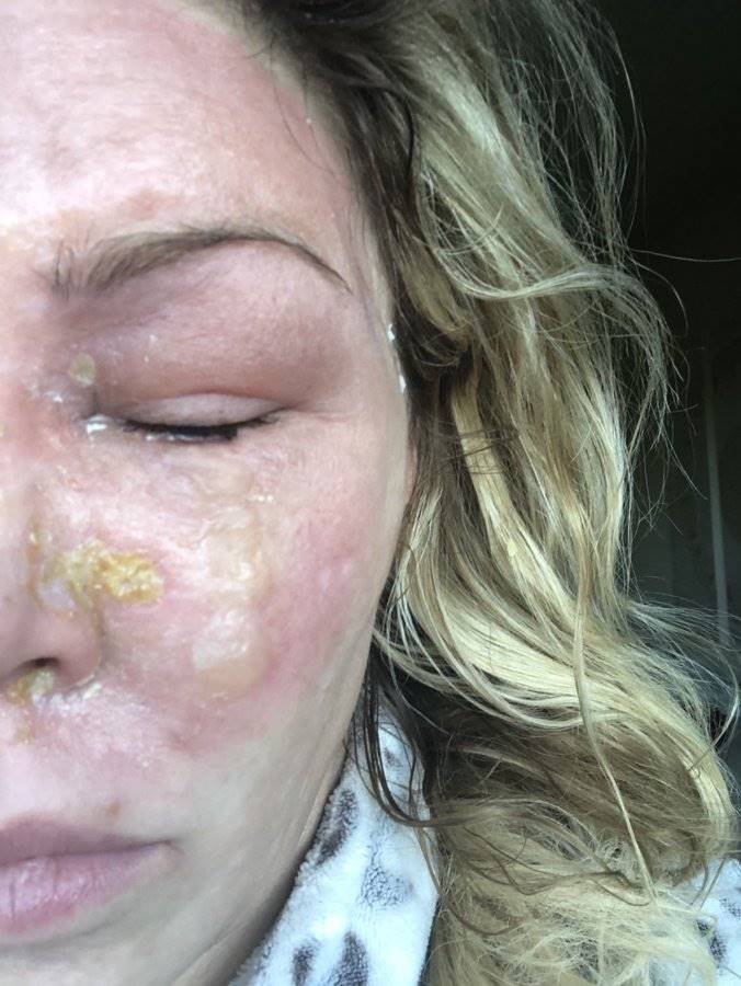Rosto de Brandi Glanville com queimaduras