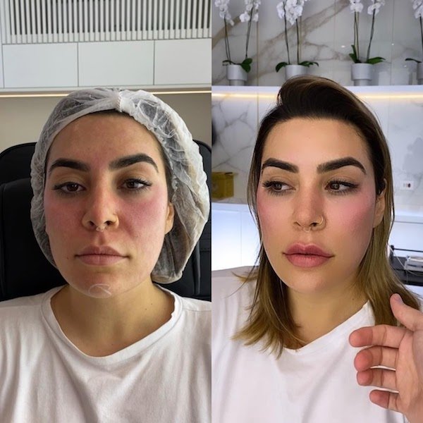 Naiara Azevedo faz harmonização facial. Compare antes e depois