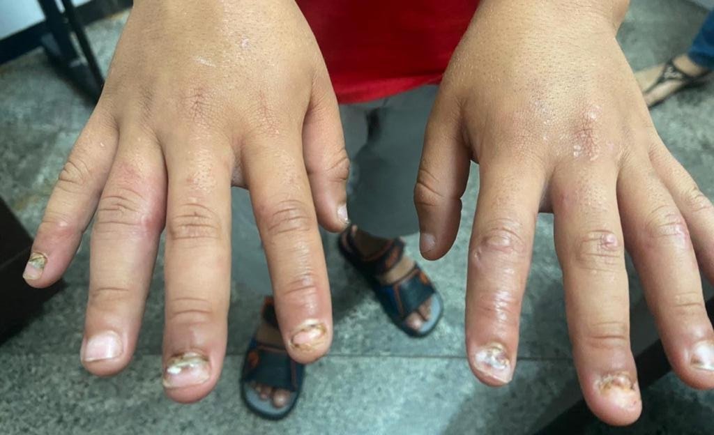 Garoto de 8 anos torturado pelo pai em Goiás