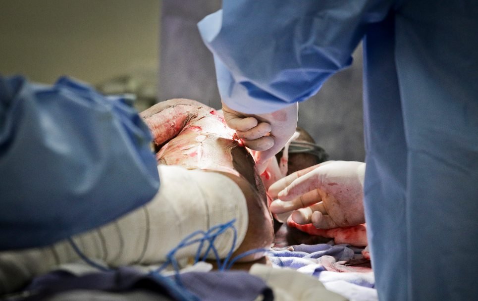 Transplante de pele em criança no Hran
