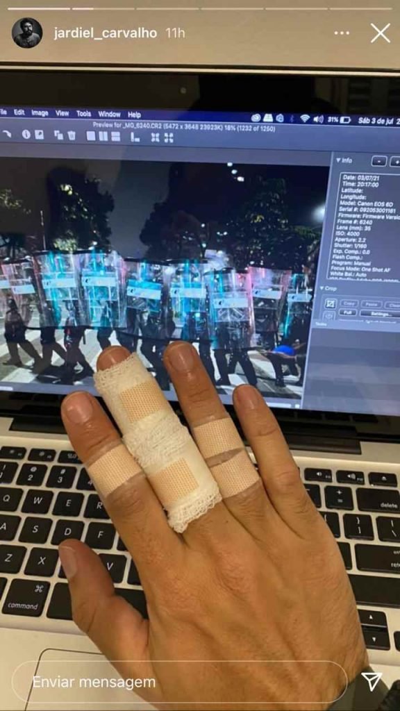 O fotojornalista Jardel Carvalho ficou com os dedos feridos