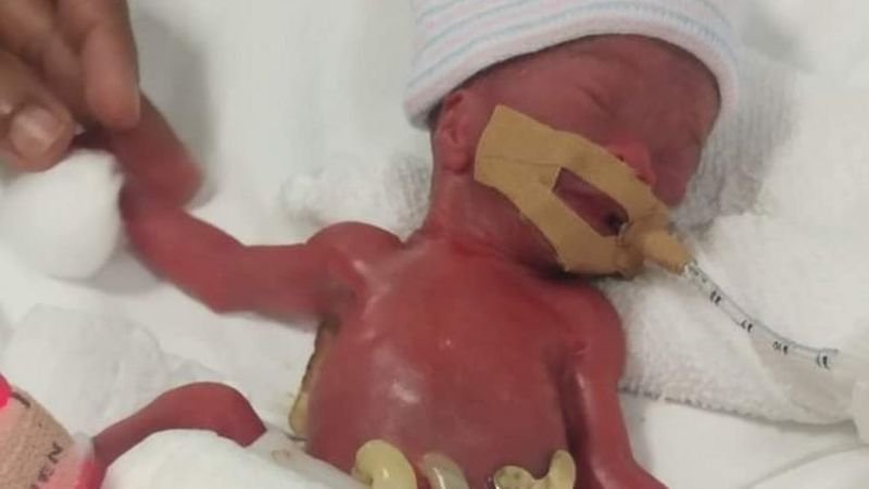 Bebê que nasceu com peso de uma maçã tem alta após 13 meses