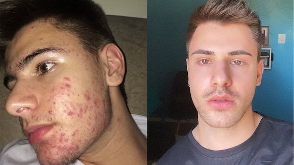 Roacutan para afinar o nariz? Médicos comentam nova trend do TikTok ...