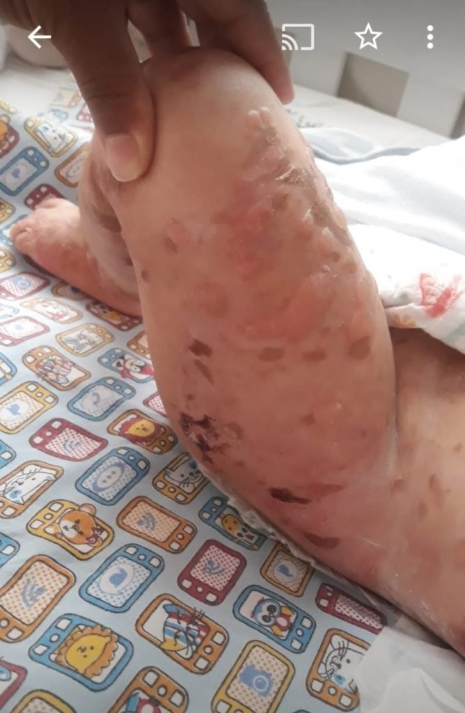 Epidermólise Bolhosa