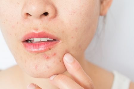 Imagem mostra rosto de mulher com acne - Metrópoles