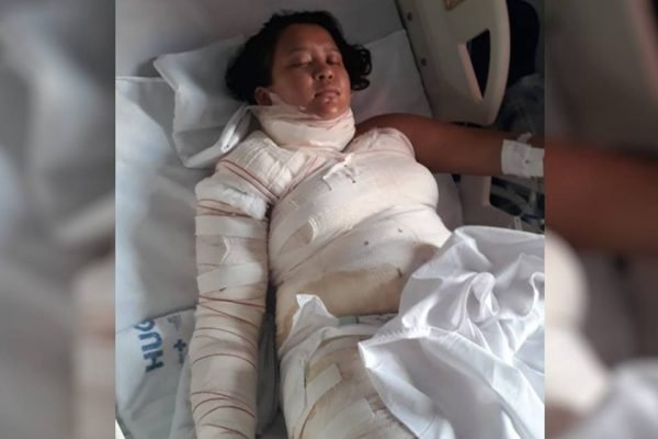 Wiviane Lima de Oliveira sofreu queimaduras ao usar álcool para acender fogo em casa, em goiás