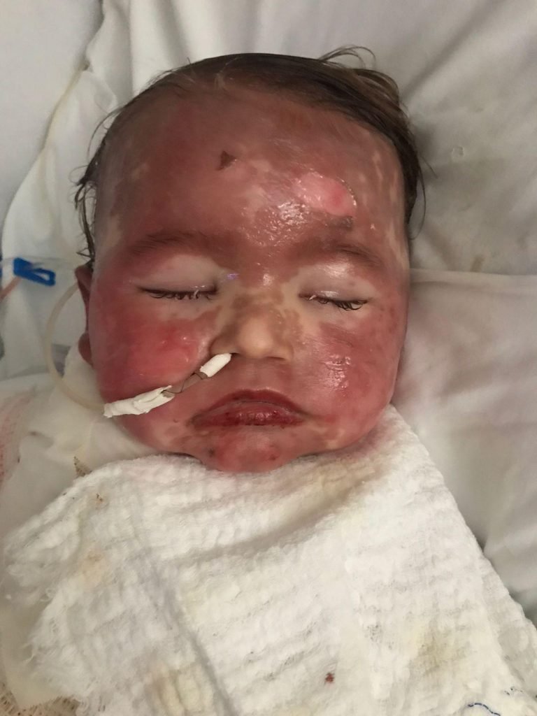 Bebê que teve 72% do corpo queimado após reação alérgica é extubado