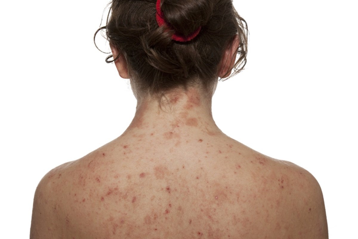 Imagem colorida de mulher com dermatite atópica