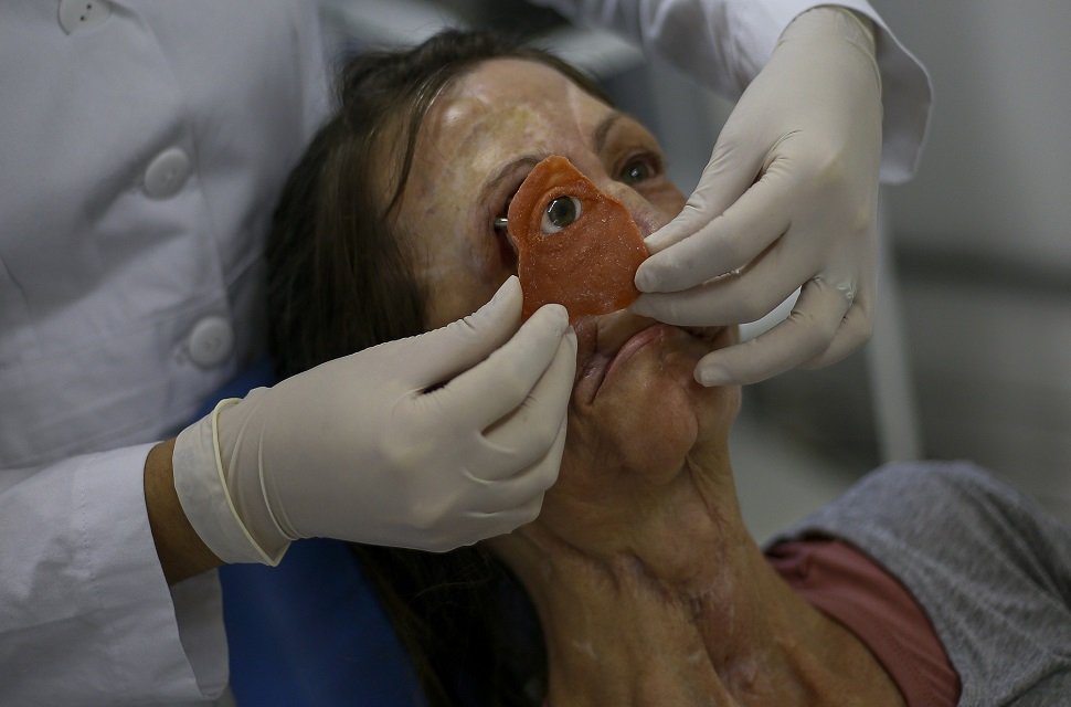 instituto faz campanha para reabilitação facial gratuita