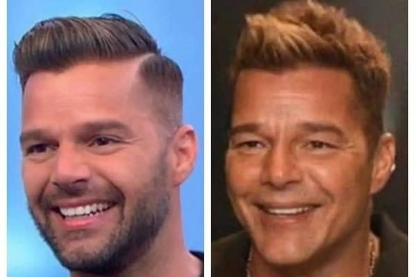 Ricky Martin antes e depois da harmonização
