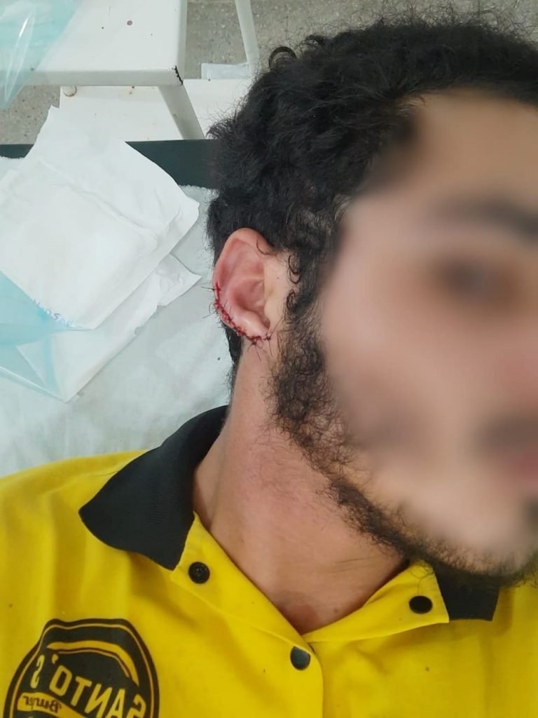 Funcionário de lanchonete que teve parte da orelha arrancada por cliente em Alagoas