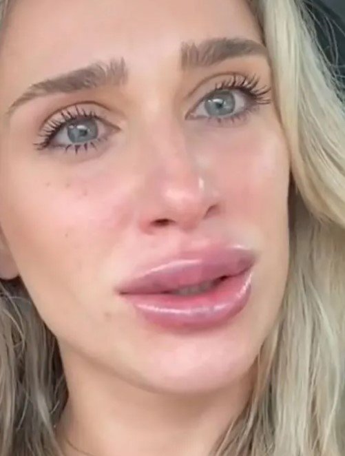 Koko Beaute e procedimento labial