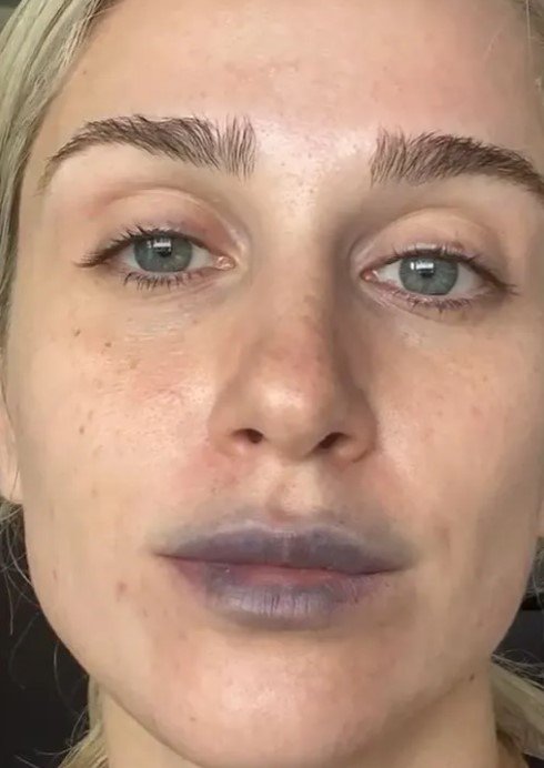 Koko Beaute e procedimento labial