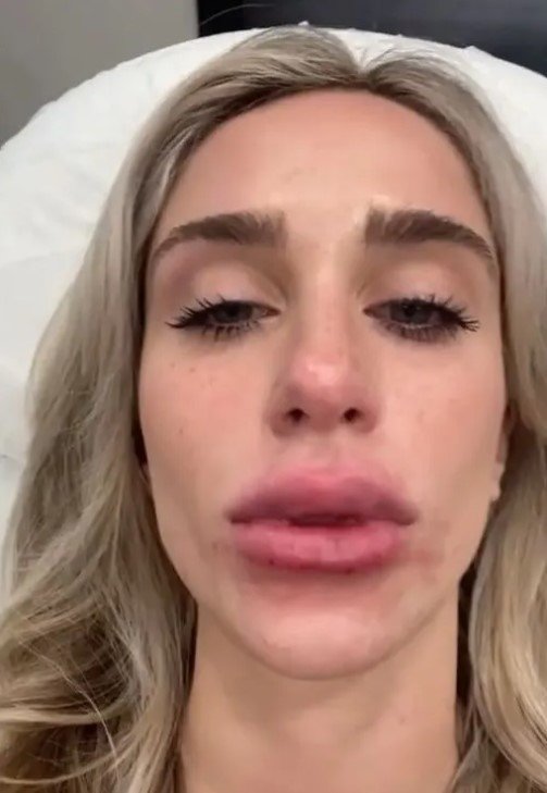 Koko Beaute e procedimento labial