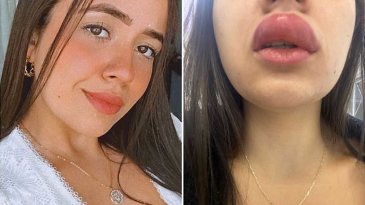 Nataly Galgino foi picada por lacraia e teve reações