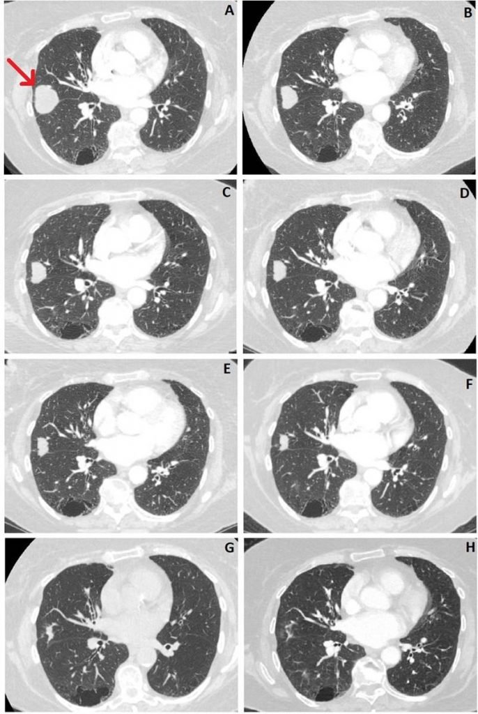Tumor cerebral - tratamento com canabidiol