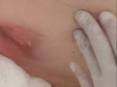 Idosa com fêmur quebrado espera há 11 dias por cirurgia no HRP