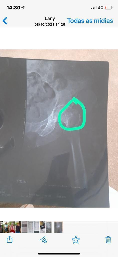 Idosa com fêmur quebrado espera há 11 dias por cirurgia no HRP