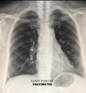 raio x de pulmão de pessoa vacinada