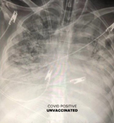 raio x de pulmão de pessoa não vacinada