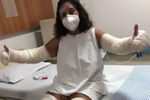 Marlene Batista teve mais de 40% do corpo queimado após frasco de desodorante explodir em Trombas, Goiás