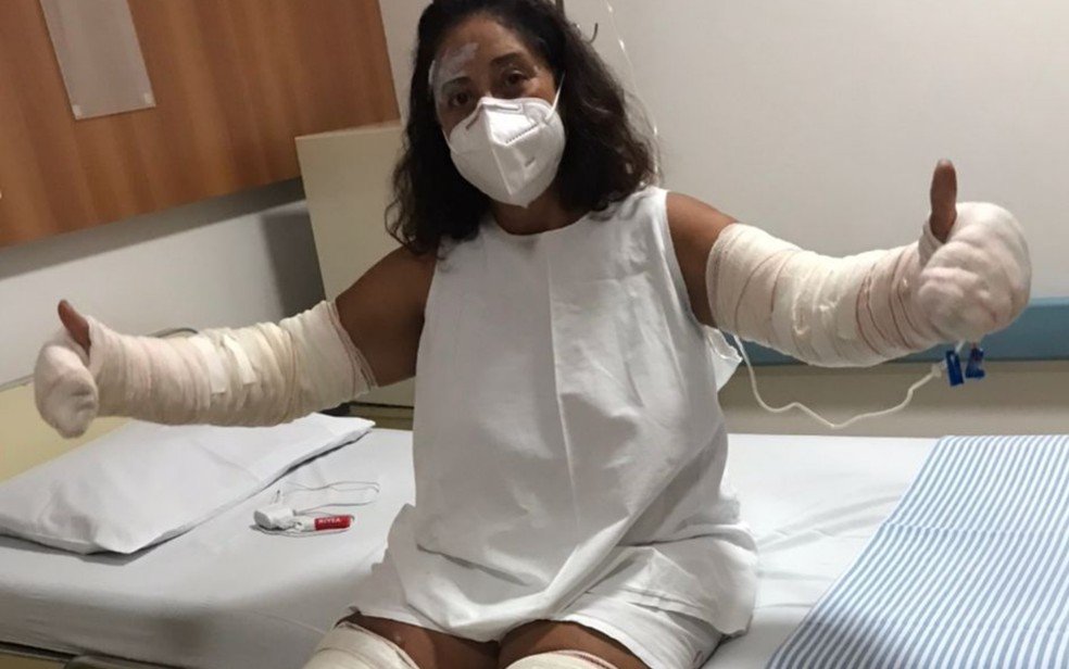 Marlene Batista teve mais de 40% do corpo queimado após frasco de desodorante explodir em Trombas, Goiás
