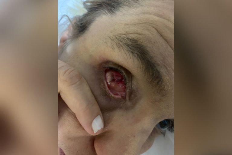 empresaria perde olho cirurgia goias