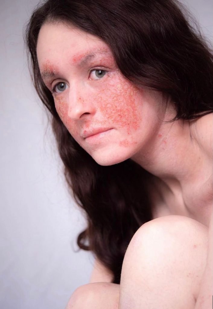 Eczema