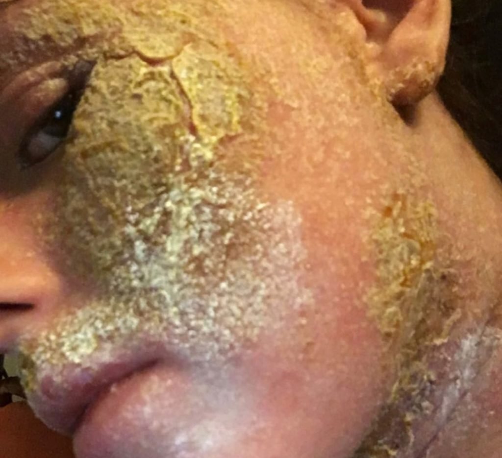 Eczema