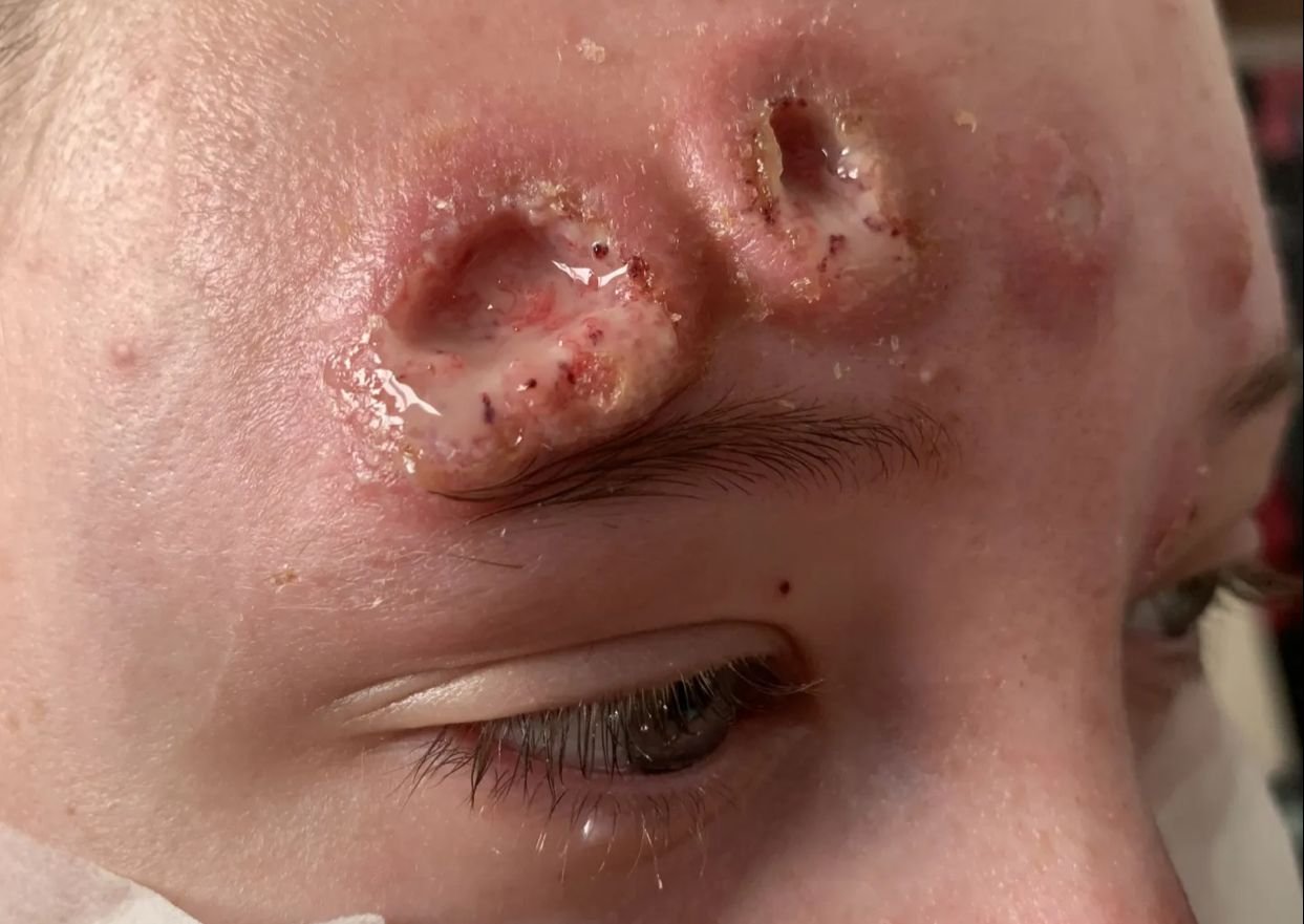 Jovem tem rosto desfigurado por feridas de 2 cm de profundidade