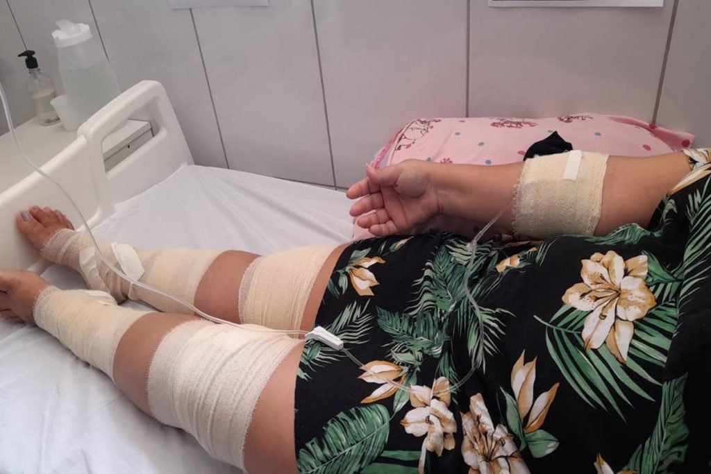 Mulher de vestido florido com pernas enfaixadas