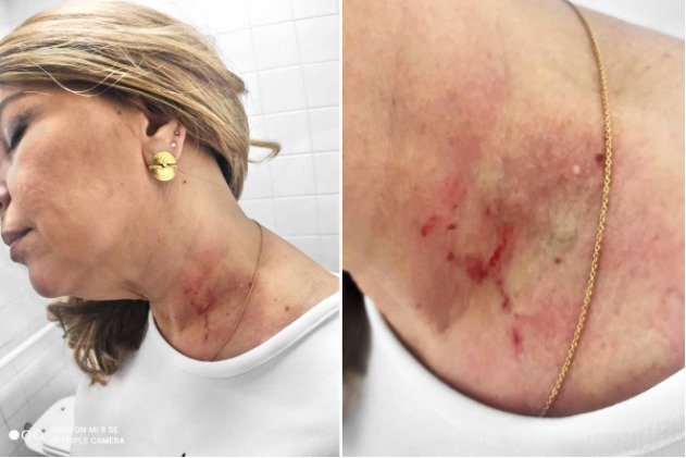 Ferimentos no pescoço da vereadora de SP Cris Monteiro após briga com correligionária Janaína Lima