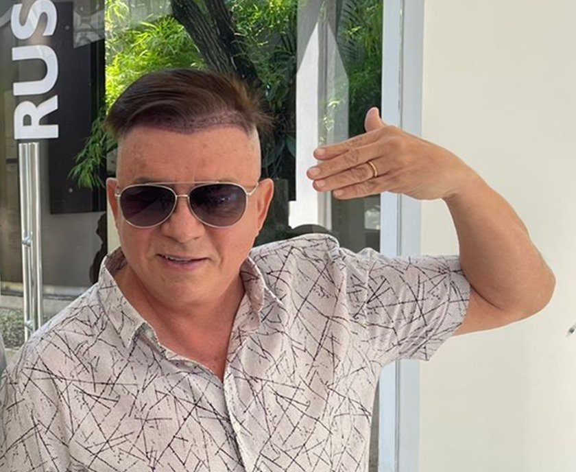 Saudades do mullet? Conheça transplante capilar feito por Chitãozinho