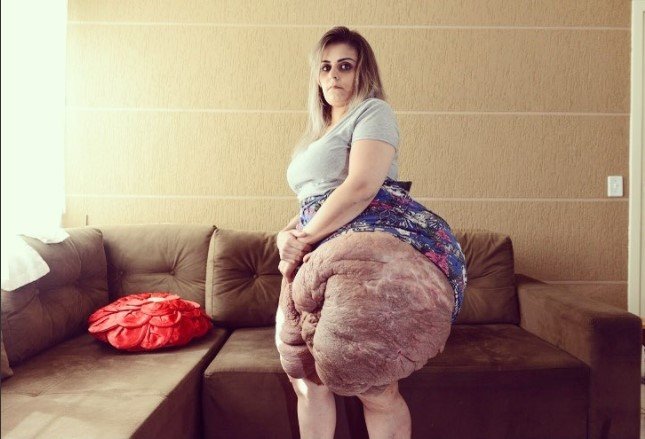 Karina mostra a evolução da neurofibromatose