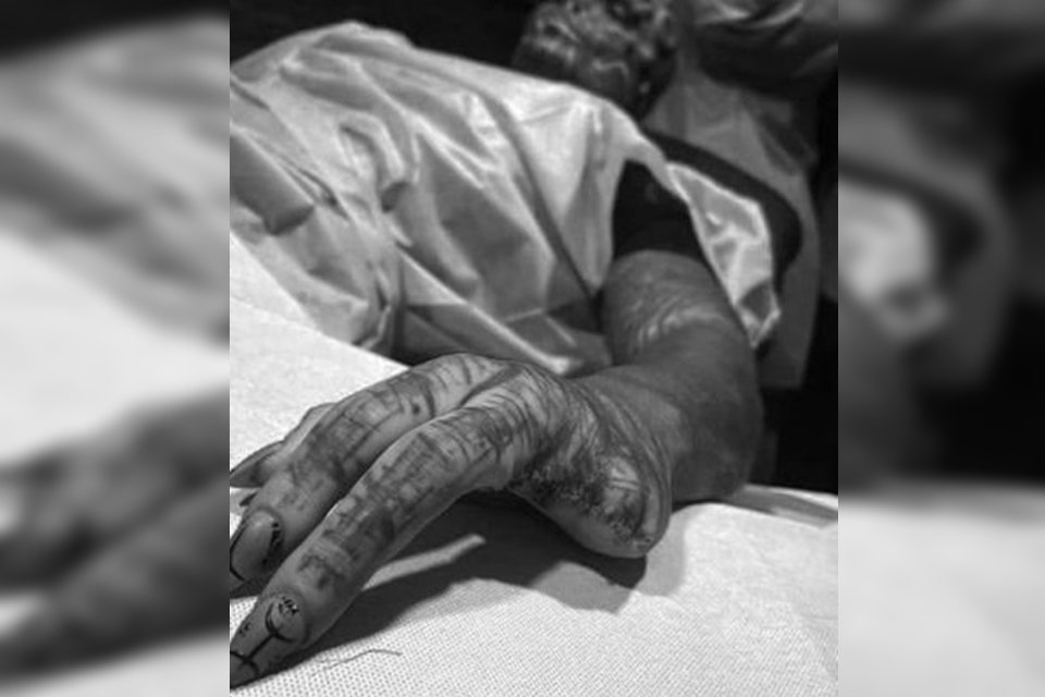 Homem tatuado amputa dois dedos para se parecer com alienígena