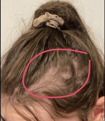 Queda de cabelo associada ao choque tóxico