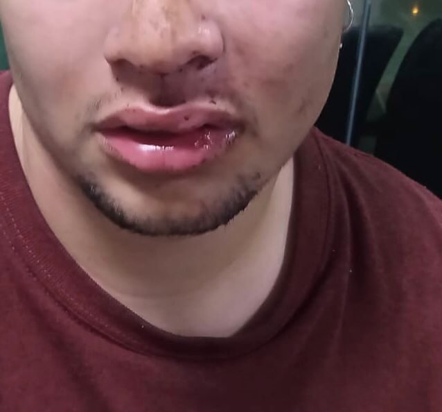 Rapaz com boca inchada