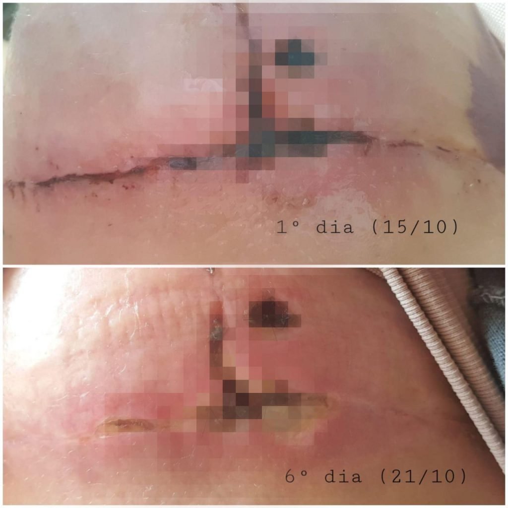 Ferida infecciona em seio