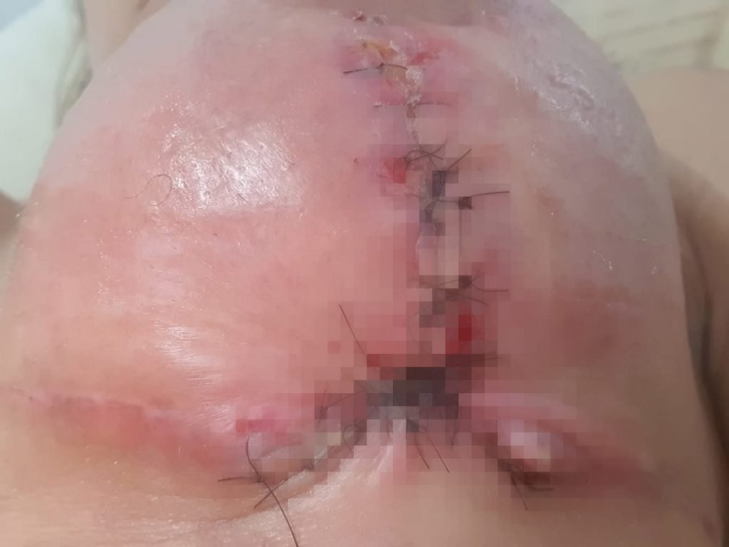 Ferida infecciona em seio