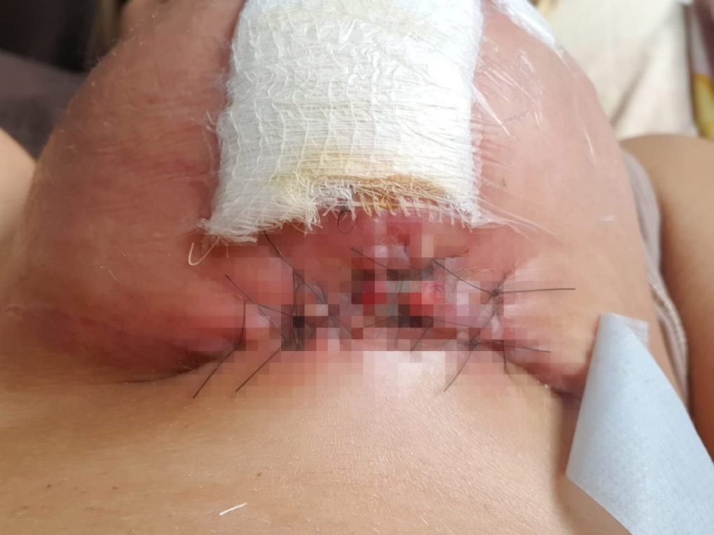 Ferida infecciona em seio