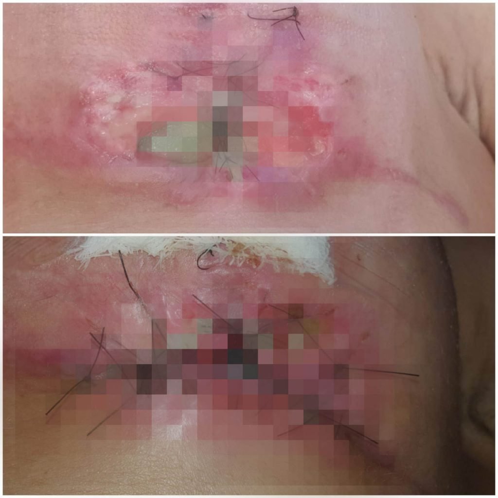 Ferida infecciona em seio