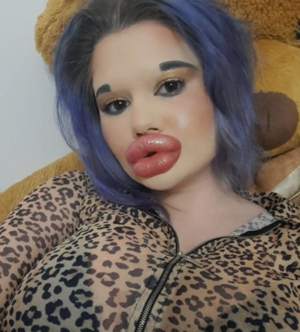 mulher com preenchimento labial