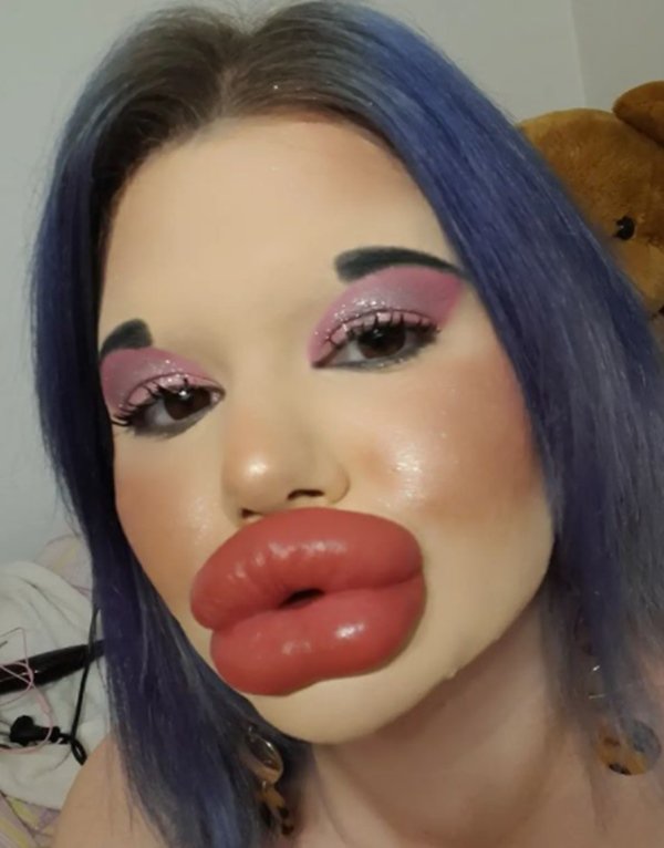 mulher com preenchimento labial