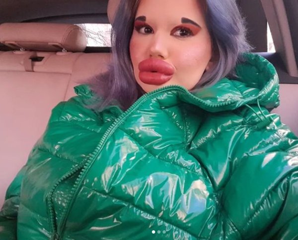 mulher com preenchimento labial