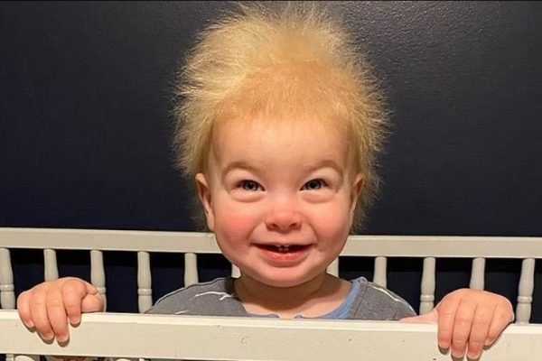 Mini-Einstein: bebê tem síndrome rara que deixa seu cabelo arrepiado
