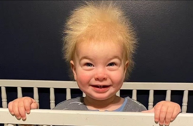 Mini Einstein Bebe Tem Sindrome Rara Que Deixa Seu Cabelo Arrepiado