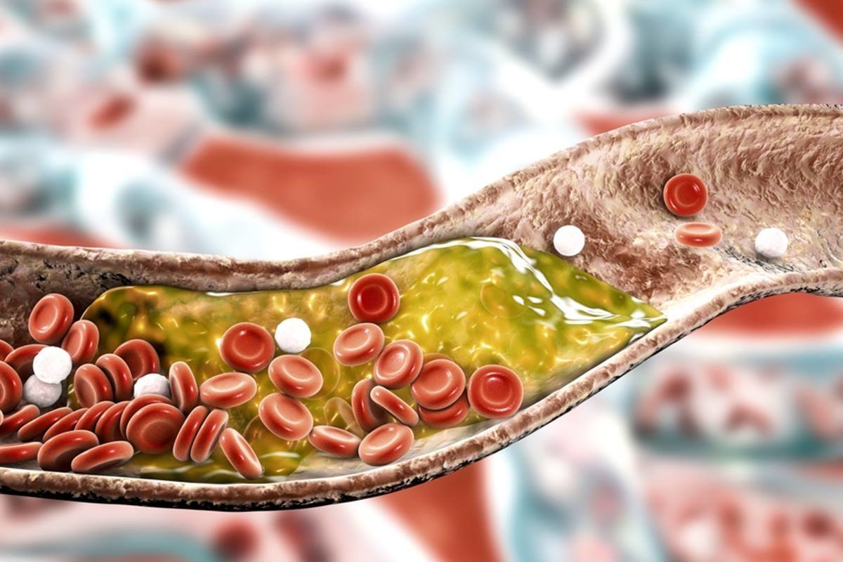 Ilustração mostra veia entupida por colesterol ruim - Metrópoles