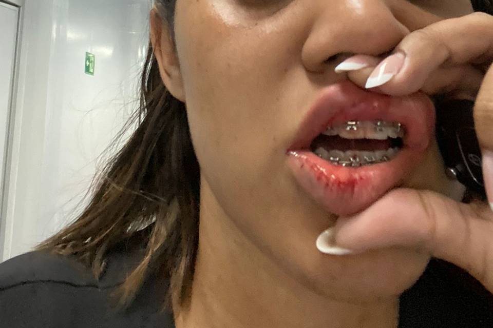 Enfermeira com boca sangrando